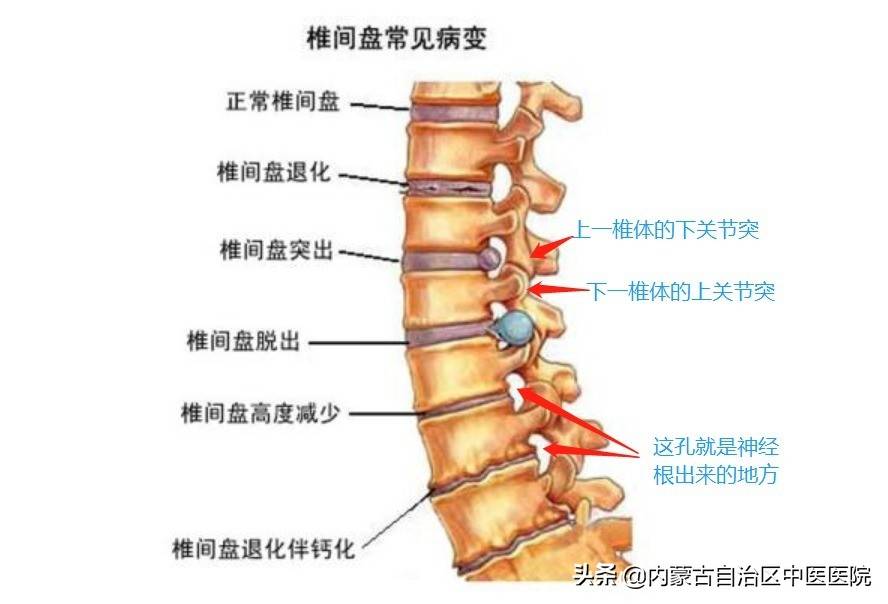 腰椎间盘突出能根治吗？