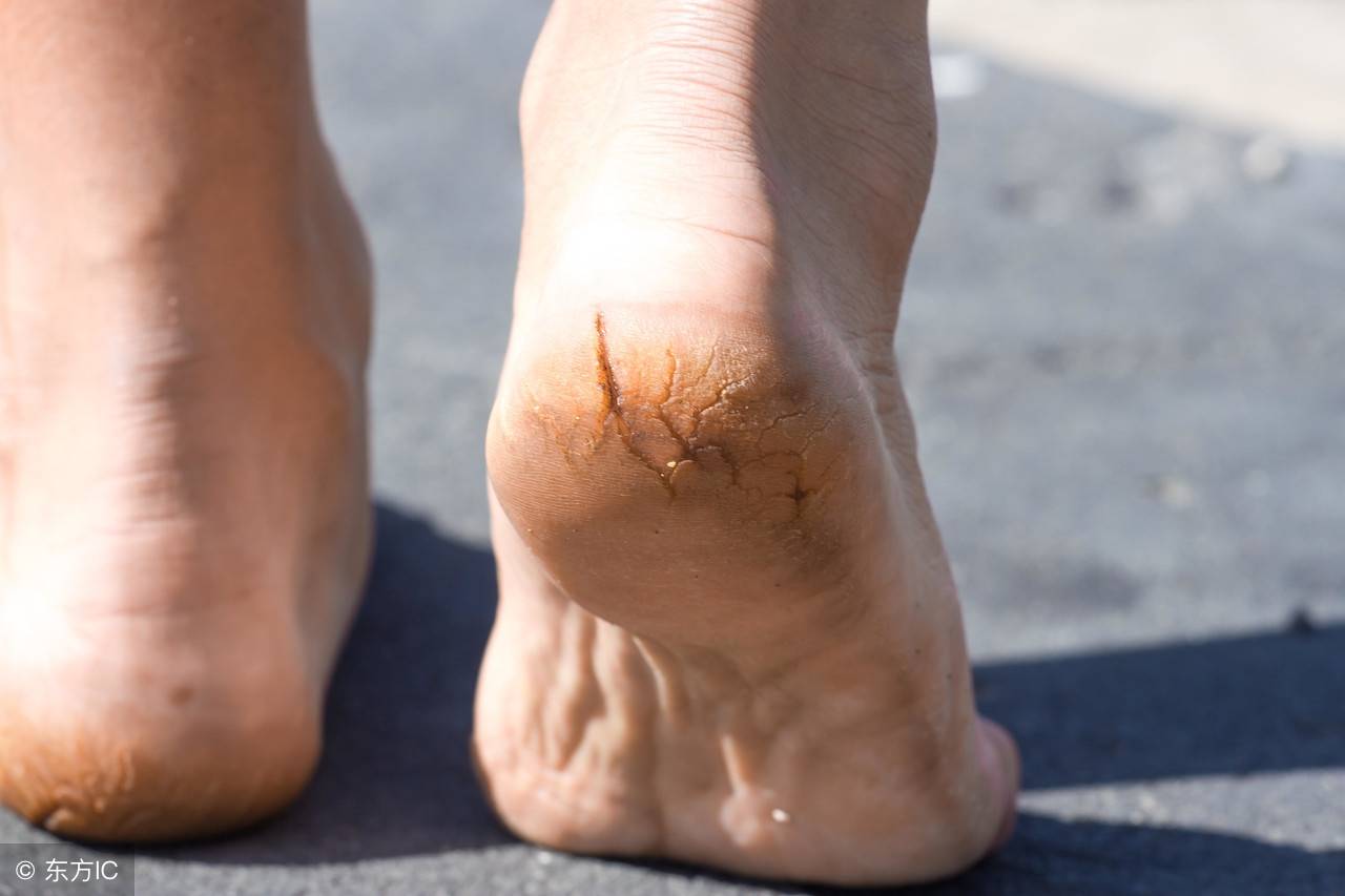 脚后跟干裂起硬皮是什么原因？该怎么办？