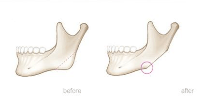 削下颌角瘦脸手术是怎样做的？