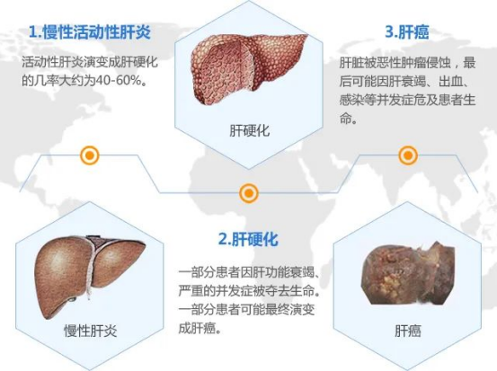 得了肝硬化还可以活多久？中医扶正补虚，有效控制肝硬化