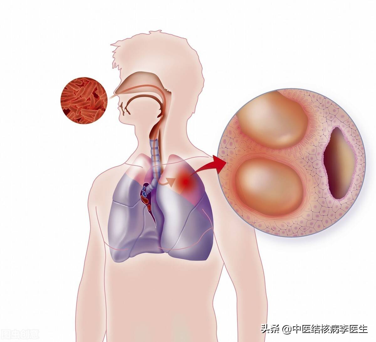 肺结核皮试出现红肿说明什么