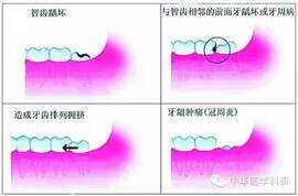 智齿是长在哪个位置（长智齿的症状有哪些）