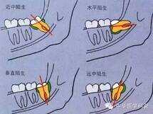 智齿是长在哪个位置（长智齿的症状有哪些）