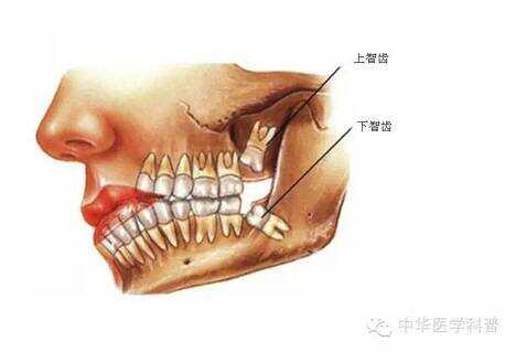 智齿是长在哪个位置（长智齿的症状有哪些）